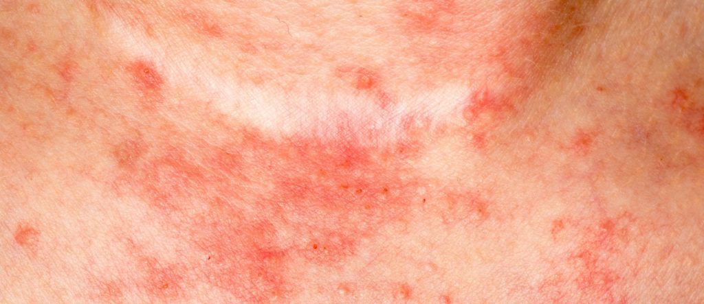 itchy rash from cold weather